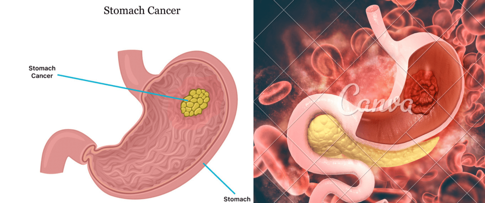 Stomach Cancer Symptoms: Recognizing the Signs Early:>