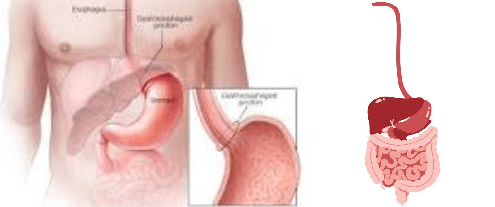 Stomach Cancer Symptoms: Recognizing the Signs Early:>